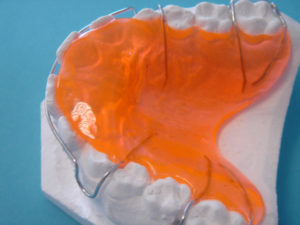 la plaque de hawley un système de rétention orthodontique